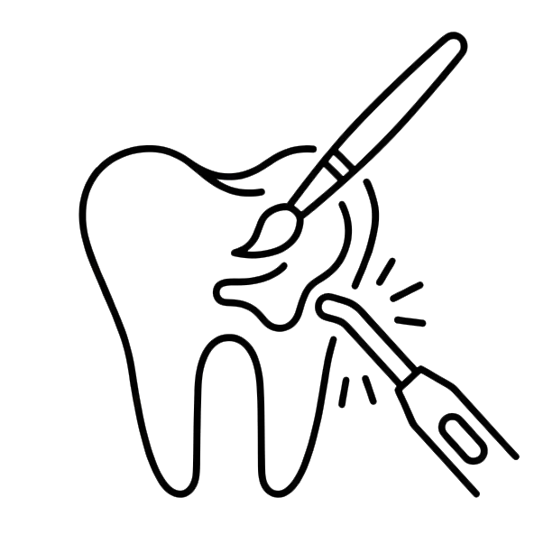 Flowable Injection Technique Composite Bonding Komposit-Veneers